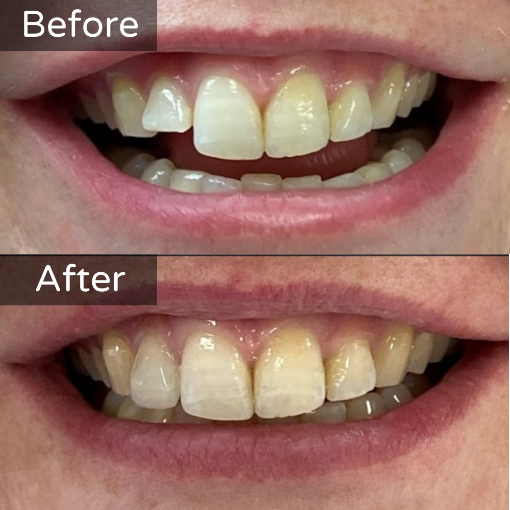 Composite Bonding Before and After 3 (1)