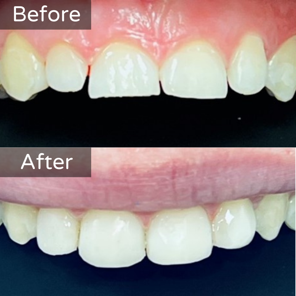 Composite Bonding Before and After 4