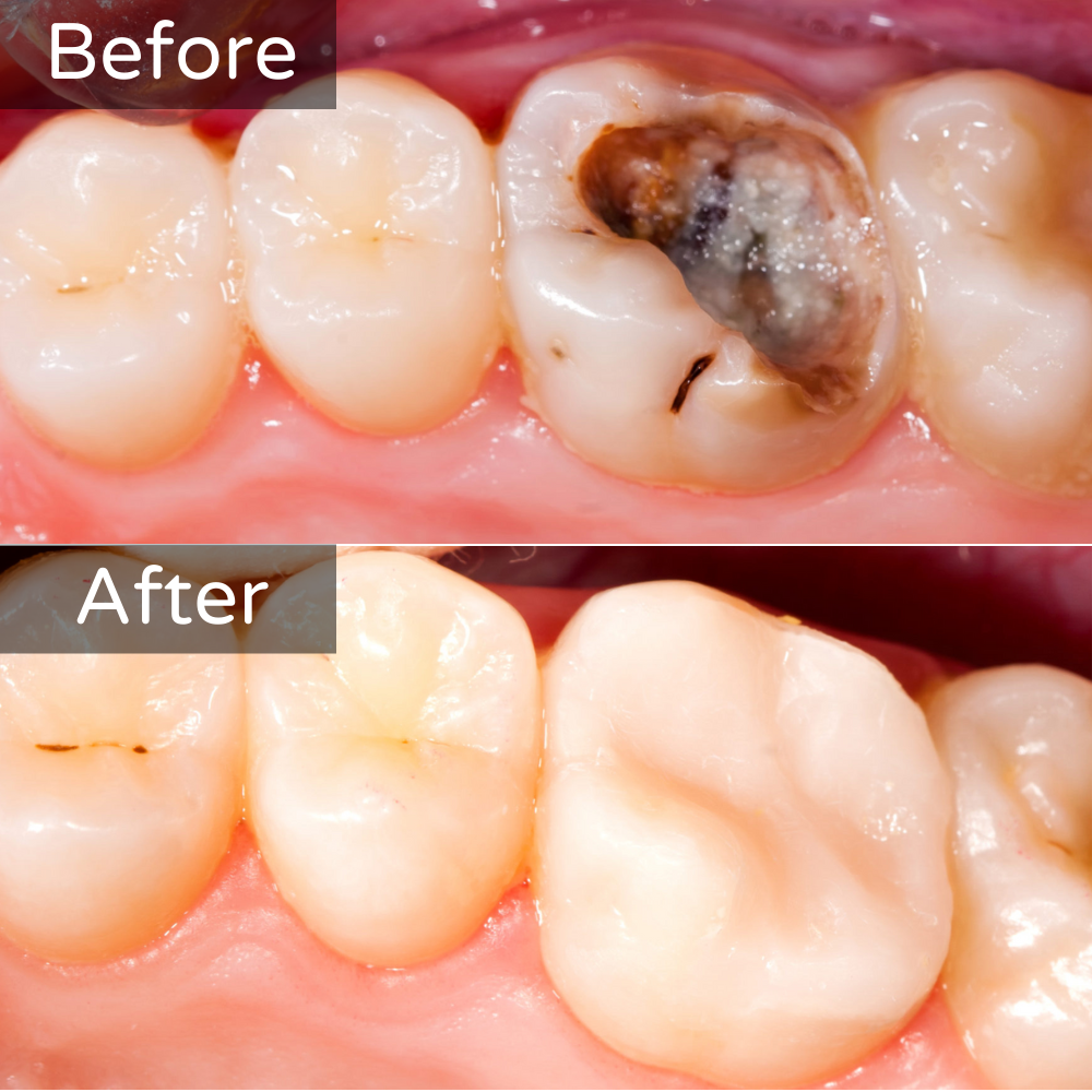 Fillings Before and After