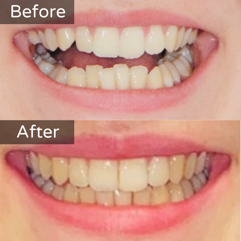 Invisalign Before and After 2