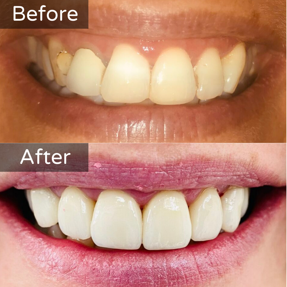 Veneers Before and After 1